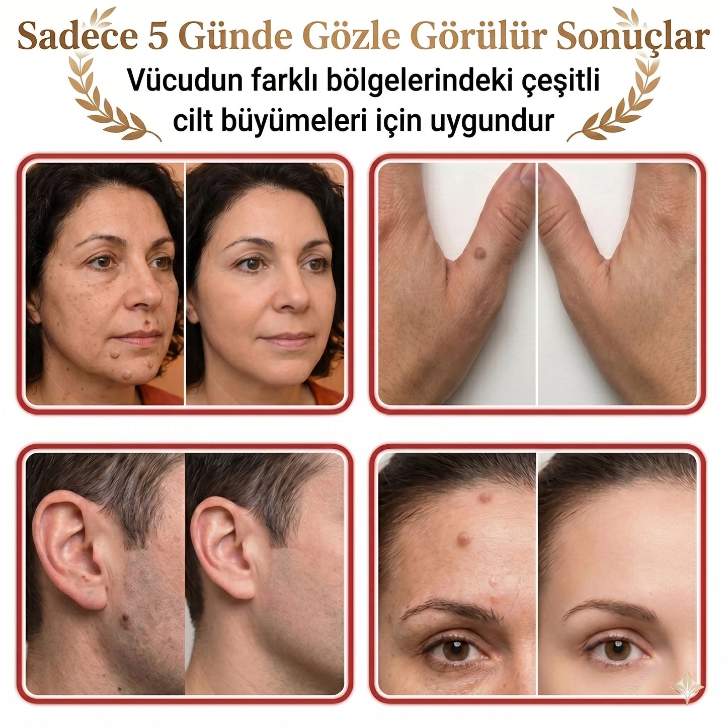 Memova Mikro İğneli Ben Ve Siğil Düşürücü Bant – 5 Günde İz Bırakmadan Düşürür