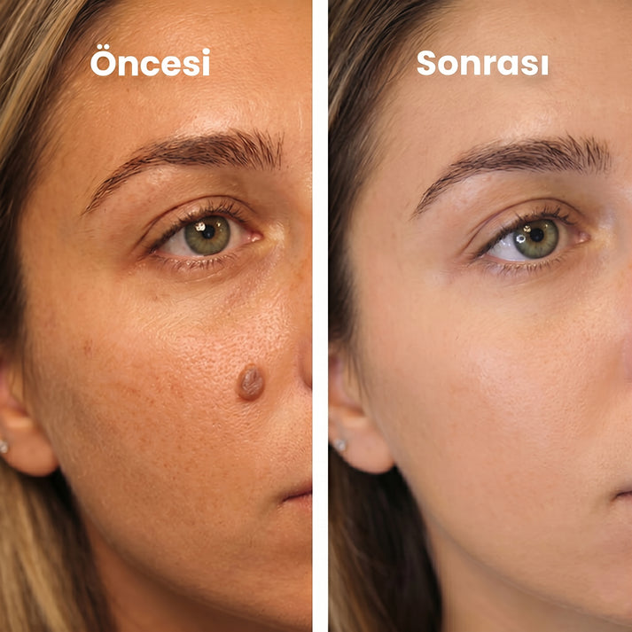 Memova Mikro İğneli Ben ve Siğil Düşürücü Bant Öncesi Sonrası