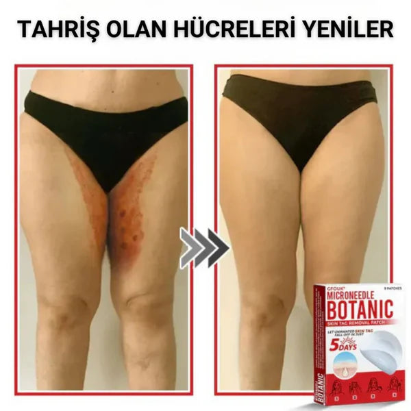 Memova Mikro İğneli Ben Ve Siğil Düşürücü Bant – 5 Günde İz Bırakmadan Düşürür