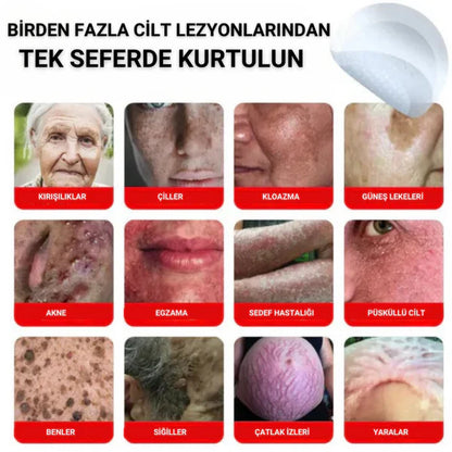 Memova Mikro İğneli Ben Ve Siğil Düşürücü Bant – 5 Günde İz Bırakmadan Düşürür
